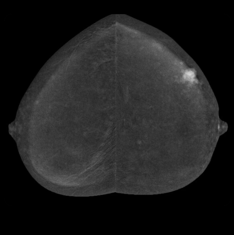 Mamografía espectral con contraste SenoBright™ HD