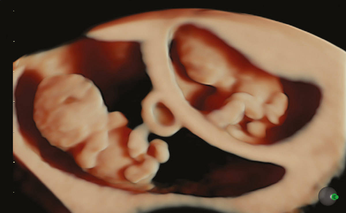9-Week Twins – Light Source Front