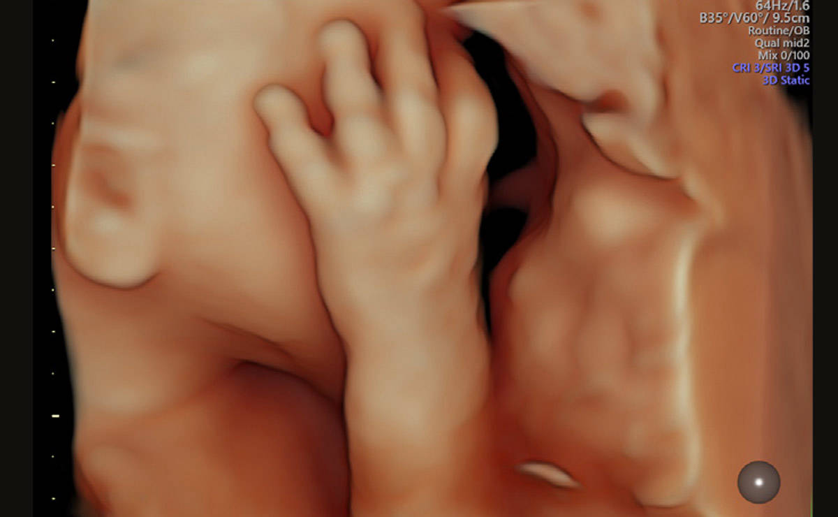 Fetal Hand and Face